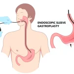 Micșorarea stomacului fără operație: ce este ESG și cum te poate ajuta să slăbești