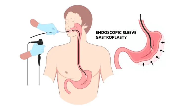 Micșorarea stomacului fără operație: ce este ESG și cum te poate ajuta să slăbești
