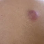 De ce nu trebuie spart niciodată un furuncul. Riscurile și tratamentul recomandat de medici