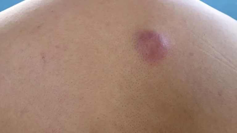 De ce nu trebuie spart niciodată un furuncul. Riscurile și tratamentul recomandat de medici