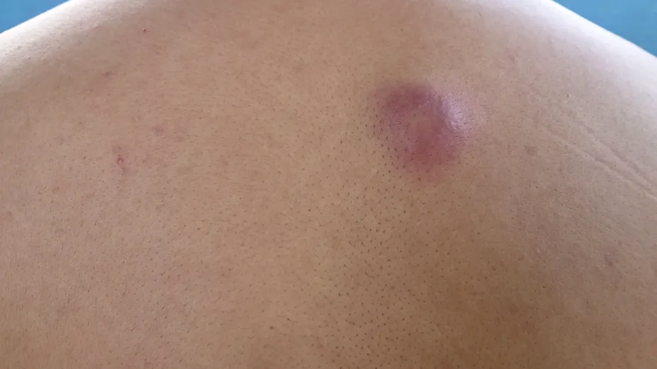 De ce nu trebuie spart niciodată un furuncul. Riscurile și tratamentul recomandat de medici