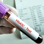 Hemoglobina glicată poate crește și din alte motive decât diabetul. Explicațiile medicilor
